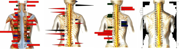 ch1-154gif。 脊椎側弯症の多くは、治ります。 背骨の歪みや側弯症で悩んでいませんか？脊柱側弯症には二つのタイプがあります。 姿勢や生活習慣による脊椎側弯症と原因不明の骨格の変形を伴う特発性の側弯症です。 特発性の側弯症の場合は、完全に治すことは、できません。 しかし、ある程度まで歪みを改善することは、可能です。 脊椎側弯症の改善に最も効果的なのが、カイロプラクティック、整体の脊椎矯正です。 静岡県磐田市、周辺の脊椎側弯症の矯正で口コミで評判の整体、カイロプラクティックの治療院はコチラ。 姿勢や生活習慣による脊椎側弯症の大半は、改善することが、可能です。 多くの側弯症悩んでいる人が改善しています。 脊柱側弯症の治療をしてみたいと思った方は、静岡県磐田市、周辺の口コミで評判のカイロプラクティック、整体まで。 多くの脊柱側弯症は、整体、カイロプラクティックの治療で改善されます。 諦めることは、ありません。 脊椎側弯症は、放置すると悪化していきます。 カイロプラクティック、整体の治療で治しましょう。 口コミで評判の静岡県磐田市、周辺の整体、カイロプラクティックの治療院は、コチラ。