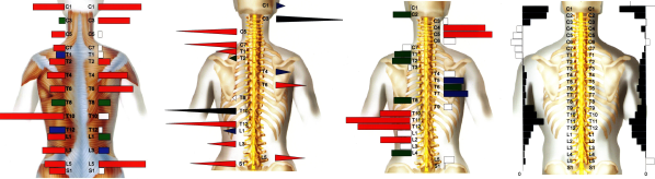 ch1-154png。 背骨の歪みや側弯症の多くは、治ります。 側弯症で悩んでいませんか？脊柱側弯症の治療に最も効果的なのが、カイロプラクティック、整体の脊椎、骨盤矯正です。 脊椎側弯症には二種類のタイプがあります。 姿勢や生活習慣による脊椎側弯症と原因のよく分からない背骨の変形を伴う特発性の脊椎側弯症です。 特発性の脊椎側弯症は、完全に改善することは、不可能です。 しかし、完全に真っ直ぐにはできなくても歪みを減らすことは、可能です。 浜松市西区の側弯症の矯正で口コミで評判のカイロプラクティック、整体の治療院はコチラ。 普段の姿勢が原因になる脊柱側弯症の大多数は、改善することが、できます。 多くの脊柱側弯症悩んでいる人が治っています。 脊椎側弯症の治療を受けたいと思った方は、浜松市中西区の口コミで評判の整体、カイロプラクティックまで。 多くの脊柱側弯症は、カイロプラクティック、整体の治療で改善されます。 諦めてはいけません。 脊椎側弯症は、放置すると悪化していきます。 整体、カイロプラクティックの治療で治しましょう。 口コミで評判の浜松市西区の整体、カイロプラクティックの治療院は、コチラ。
