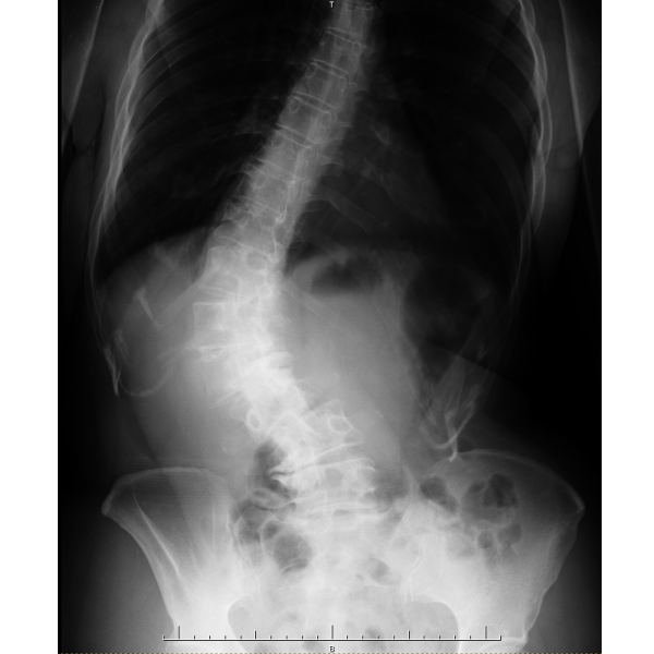 ch1-200jpg。 側弯症の多くは、良くなります。 脊椎側弯症で悩んでいませんか？脊椎側弯症には二つのタイプがあります。 普段の姿勢が原因になる脊椎側弯症と原因のよく分からない咳津の変形を伴う特発性の脊椎側弯症です。 特発性の脊椎側弯症の場合は、完全に良くすることは、できません。 しかし、ある程度まで歪みを改善することは、できます。 脊椎側弯症の治療に最も効果は発揮するのが、カイロプラクティック、整体の背骨矯正です。 静岡県磐田市、周辺の脊柱側弯症の矯正で口コミで評判のカイロプラクティック、整体の治療院はコチラ。 姿勢や生活習慣による側弯症の多くは、良くすることが、可能です。 多くの脊椎側弯症で悩む人が治っています。 側弯症の治療を受けたいと思った方は、静岡県磐田市、周辺の口コミで評判の整体、カイロプラクティックまで。 多くの側弯症は、整体、カイロプラクティックの治療で改善されます。 諦めてはいけません。 脊柱側弯症は、そのままにしておくとどんどん悪くなっていきます。 カイロプラクティック、整体の治療で治しましょう。 口コミで評判の静岡県磐田市、周辺の整体、カイロプラクティックの治療院は、コチラ。