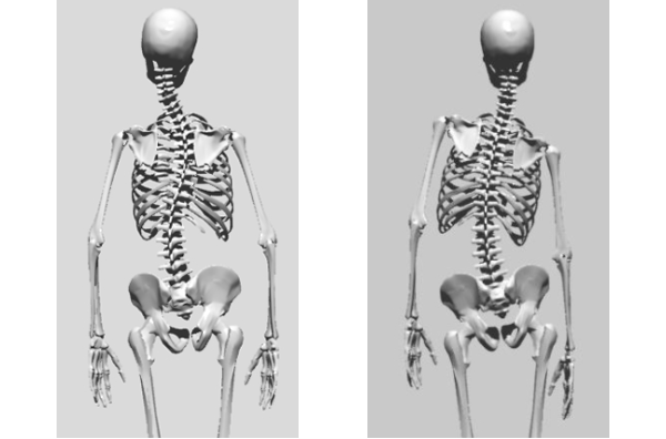 ch1-201png。静岡県磐田市、周辺のカイロプラクティック、整体。 脊椎側弯症の多くは、良くなります。 背骨の歪みや側弯症で悩んでいませんか？脊椎側弯症には二種類のタイプがあります。 普段の姿勢が原因になる脊椎側弯症と原因のよく分からない骨格の変形を伴う特発性の脊椎側弯症です。 特発性の側弯症の場合は、完全に治癒させることは、不可能です。 しかし、ある程度まで歪みを軽減することは、できます。 脊椎側弯症の治療に最も効果は発揮するのが、整体、カイロプラクティックの脊椎、骨盤矯正です。 静岡県磐田市、周辺の脊椎側弯症の矯正で口コミで評判のカイロプラクティック、整体の治療院はコチラ。 日常生活の癖が原因の側弯症の多くは、良くすることが、できます。 多くの脊柱側弯症悩んでいる人が治っています。 側弯症の治療をしてみたいと思った方は、静岡県磐田市、周辺の口コミで評判の整体、カイロプラクティックまで。 多くの脊椎側弯症は、整体、カイロプラクティックの治療で改善されます。 諦めてはいけません。 脊椎側弯症は、放置するとどんどん悪くなっていきます。 カイロプラクティック、整体の治療で治しましょう。 口コミで評判の静岡県磐田市、周辺の整体、カイロプラクティックの治療院は、コチラ。