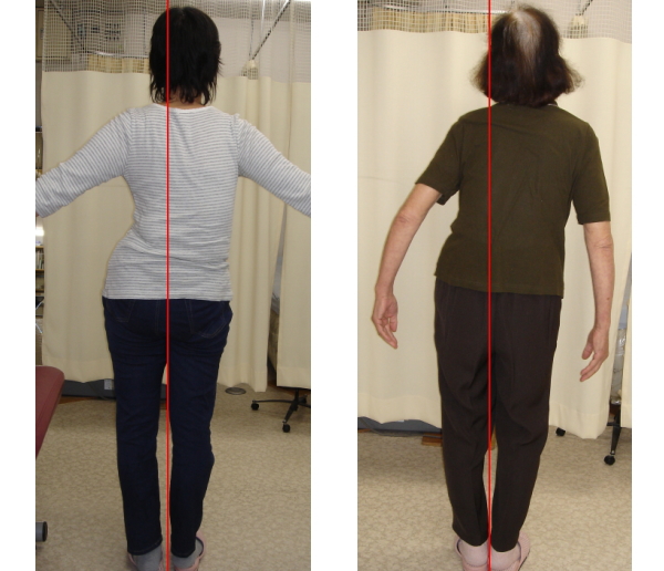 ch1-203jpg。 背骨の歪みや側弯症の多くは、改善できます。 背骨の歪みや側弯症で困っていませんか？脊柱側弯症の治療に最も効果は発揮するのが、整体、カイロプラクティックの脊椎矯正です。 脊椎側弯症には二つのタイプがあります。 普段の姿勢が原因になる側弯症と原因の特定できない咳津の変形を伴う特発性の脊柱側弯症です。 特発性の脊椎側弯症の場合は、完全に良くすることは、不可能です。 しかし、完全に真っ直ぐにはできなくても歪みを減らすことは、できます。 浜松市東区の側弯症の矯正で口コミで評判のカイロプラクティック、整体の治療院はコチラ。 姿勢や生活習慣による脊柱側弯症の多くは、改善することが、できます。 多くの側弯症で悩む人が良くなっています。 側弯症の治療をしてみたいと思った方は、浜松市中東区の口コミで評判のカイロプラクティック、整体まで。 多くの脊椎側弯症は、カイロプラクティック、整体の治療で改善されます。 諦めることは、ありません。 側弯症は、そのままにしておくとどんどん悪くなっていきます。 カイロプラクティック、整体の治療で治しましょう。 口コミで評判の浜松市東区のカイロプラクティック、整体の治療院は、コチラ。