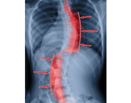 脊椎側彎症とカイロプラクティック・整体の施術