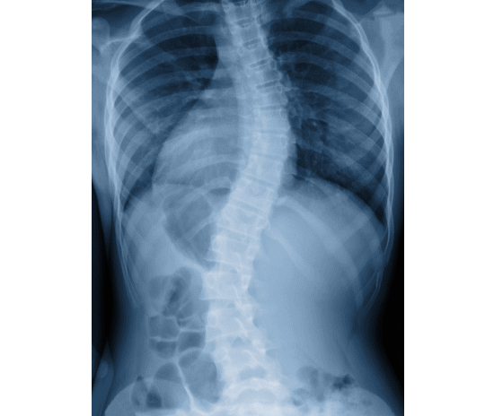 脊椎側彎症とカイロプラクティック、整体の背骨矯正