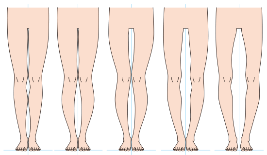 カイロプラクティック、整体、整骨院のO脚矯正とO脚の治し方（浜松市）