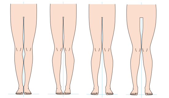 X脚の治し方とカイロプラクティック、整体、整骨院のX脚矯正