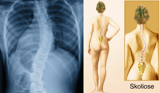 側弯症の治し方とカイロプラクティック、整体、整骨院の側弯症の治療