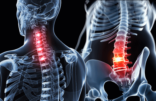 椎間板ヘルニアの治し方とカイロプラクティック、整体、整骨院の治療法