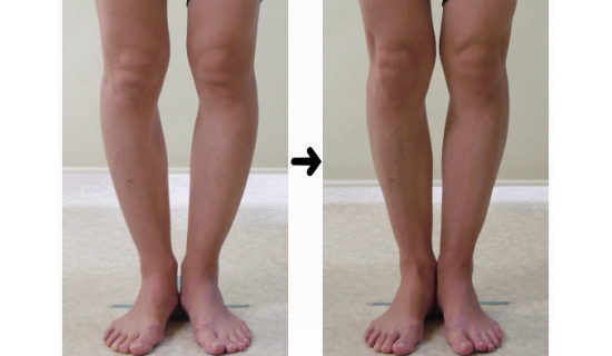 O脚の治し方とカイロプラクティック、整体、整骨院のO脚を改善するO脚矯正