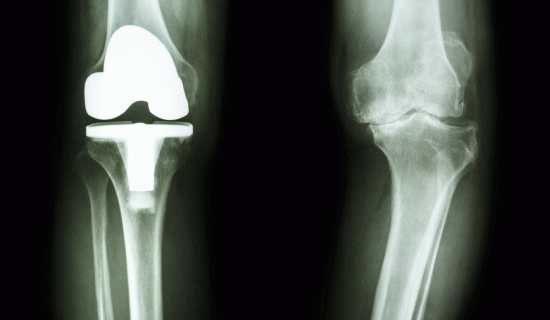 「o脚」の膝の変形と整体とカイロプラクティックの治療法