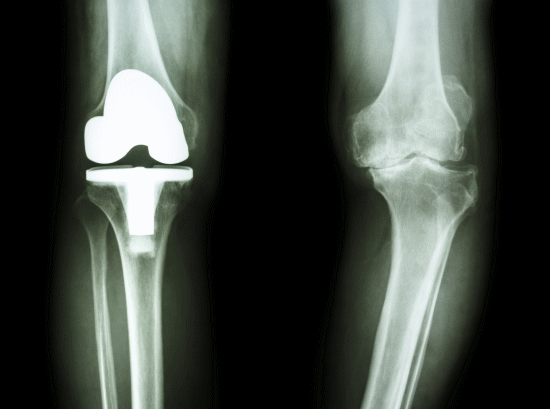X脚を改善する方法とカイロプラクティック、整体、整骨院のX脚の治し方（浜松市）