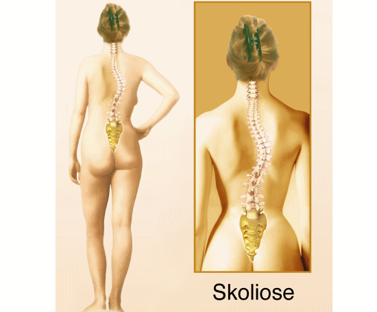 側彎症を治す方法とカイロプラクティック、整体、整骨院の側弯症の矯正