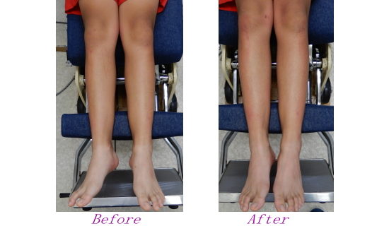 X脚を改善する方法と浜松市のカイロプラクティック、整体、整骨院のX脚の矯正