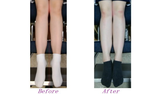 X脚を改善する治療法とカイロプラクティック、整体、整骨院のX脚矯正